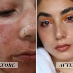 Acne Scar Removal Treatments