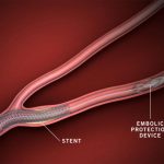 Embolic Protection Devices Market Report