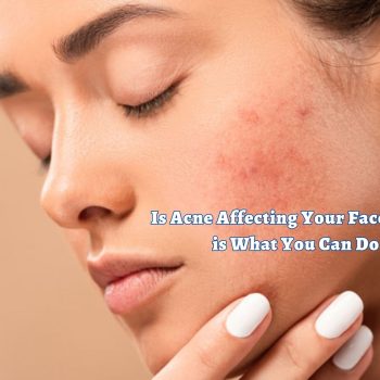 Is Acne Affecting Your Face Here is What You Can Do