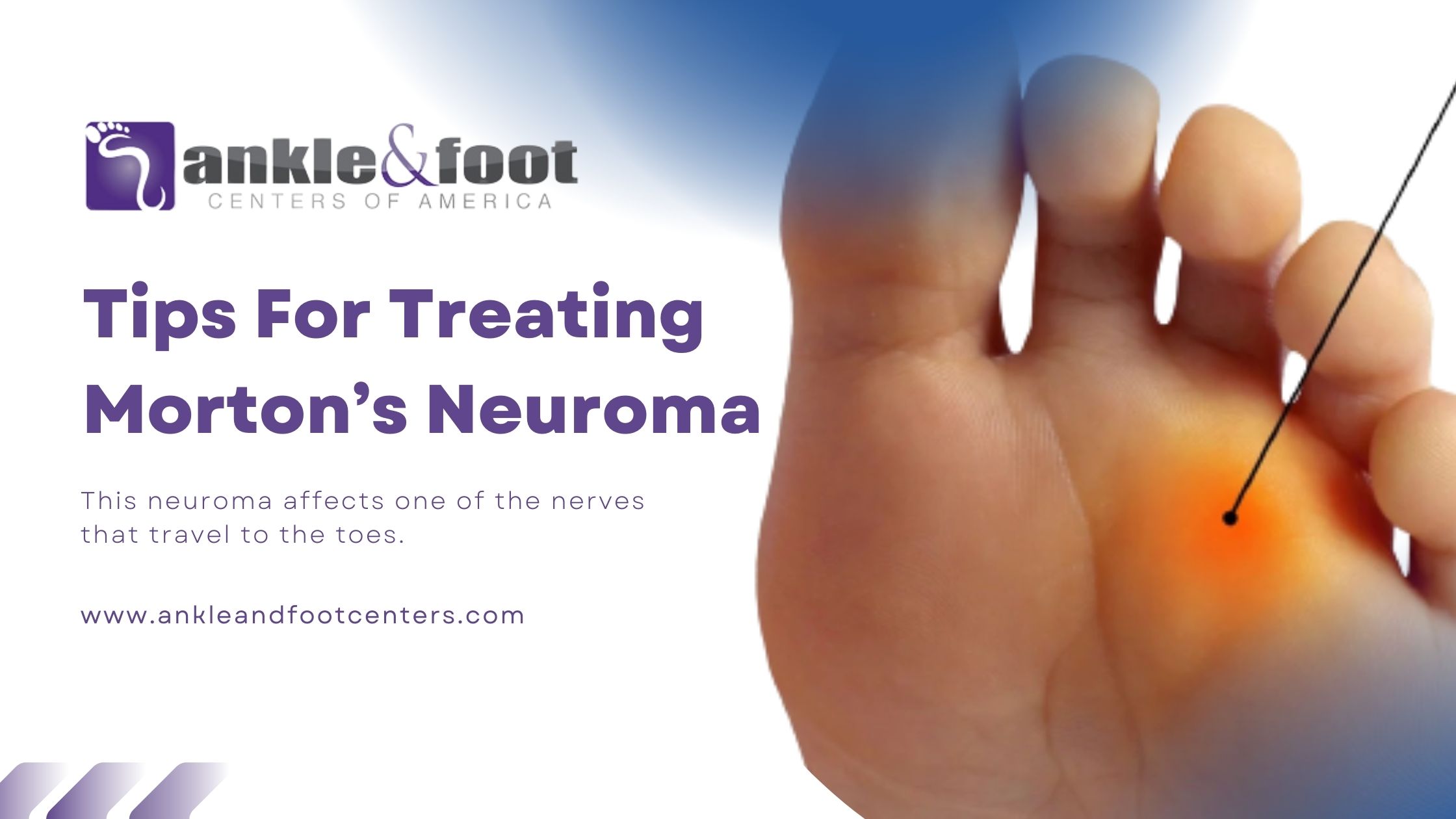 Tips For Treating Morton’s Neuroma