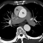 aortic dissection