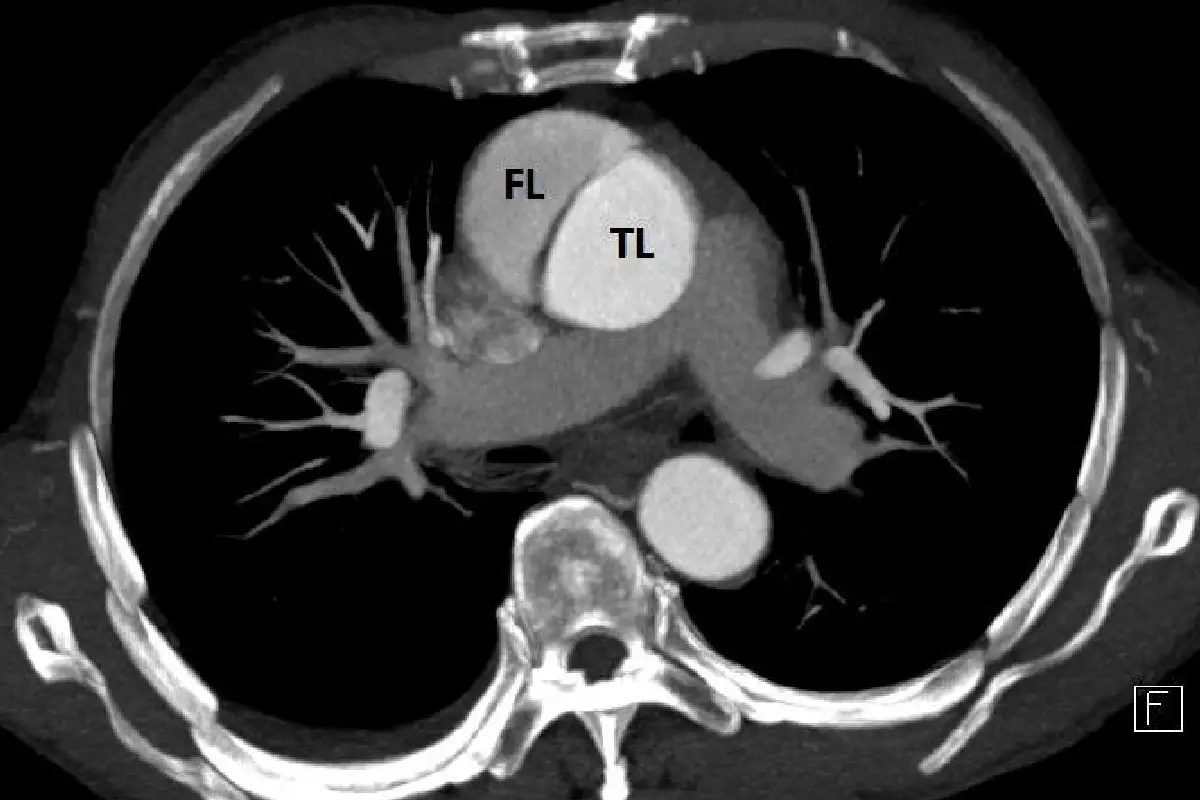 aortic dissection