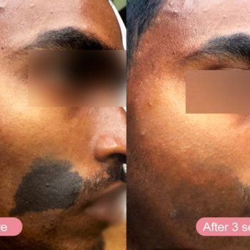 birthmark-removal-before-after