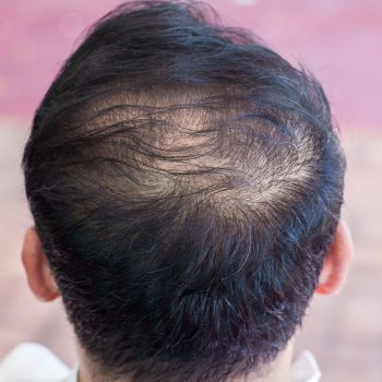 hair-thinning-and-prevent-balding-feat-1