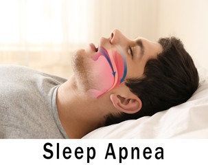 Apnea Sleep