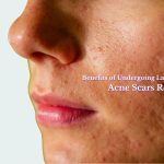 Benefits of Undergoing Laser Treatment for Acne Scars Removal