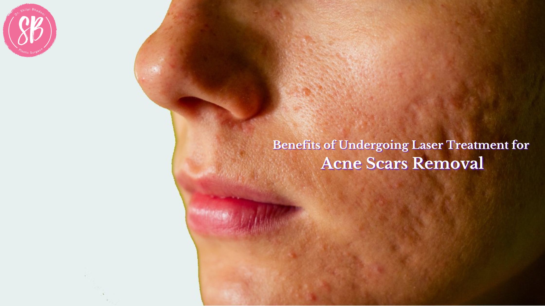 Benefits of Undergoing Laser Treatment for Acne Scars Removal