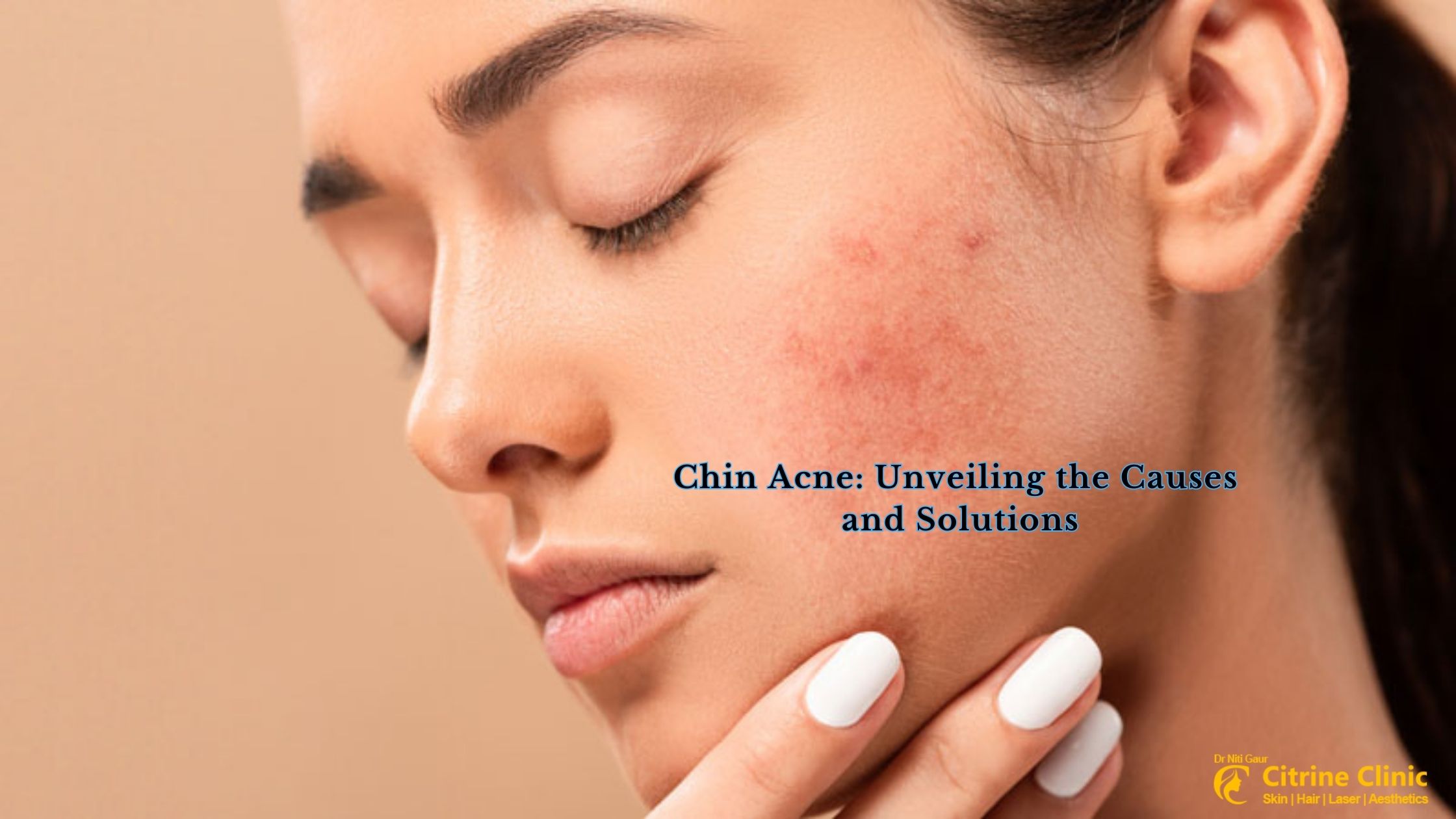 Chin Acne Unveiling the Causes and Solutions
