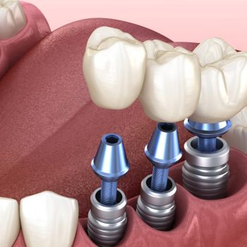 Dental Implants tallahassee fl