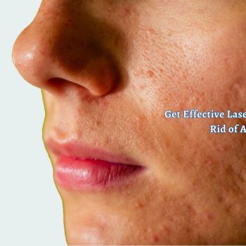 Get Effective Laser Treatment to Get Rid of Acne Scars