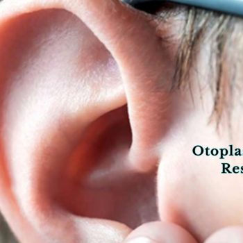 Otoplasty For Ear Reshaping