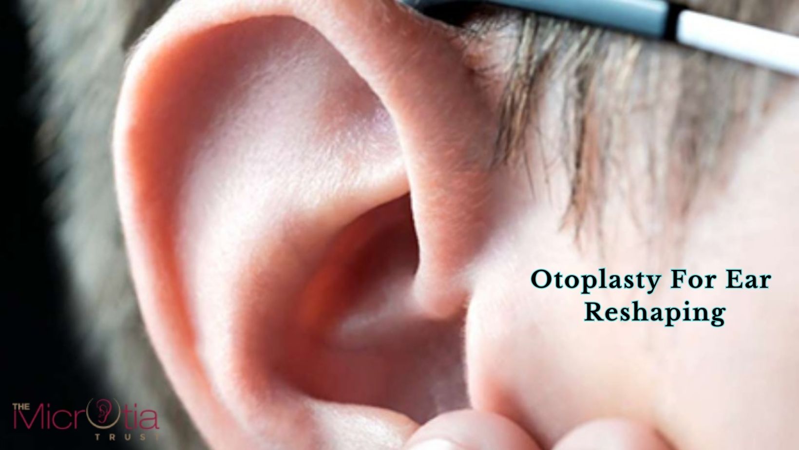 Otoplasty For Ear Reshaping
