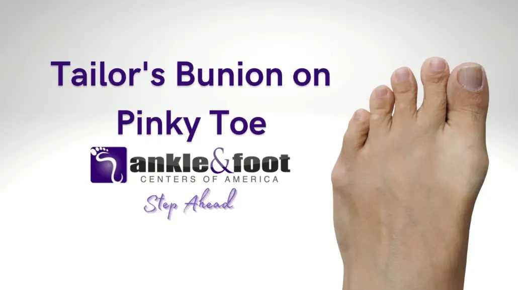 Tailors-Bunion-on-Pinky-Toe-1030x578