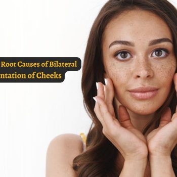 Understanding the Root Causes of Bilateral Hyperpigmentation of Cheeks