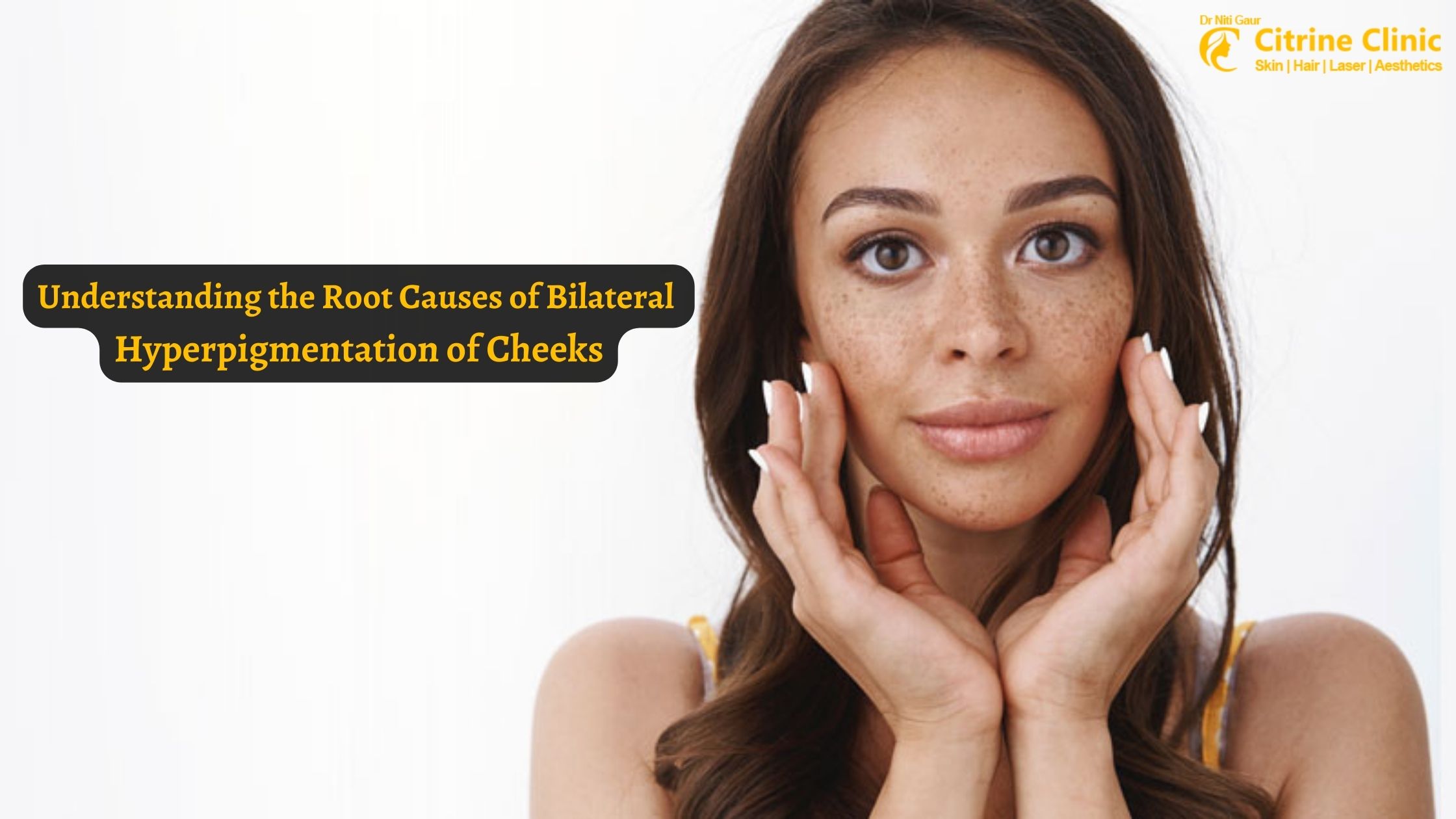 Understanding the Root Causes of Bilateral Hyperpigmentation of Cheeks