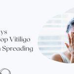 Vitiligo Treatment