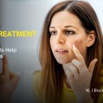 acne scar treatment in Ludhiana