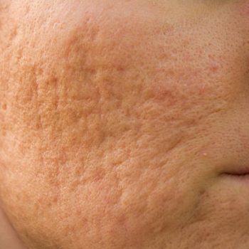 acne scar img