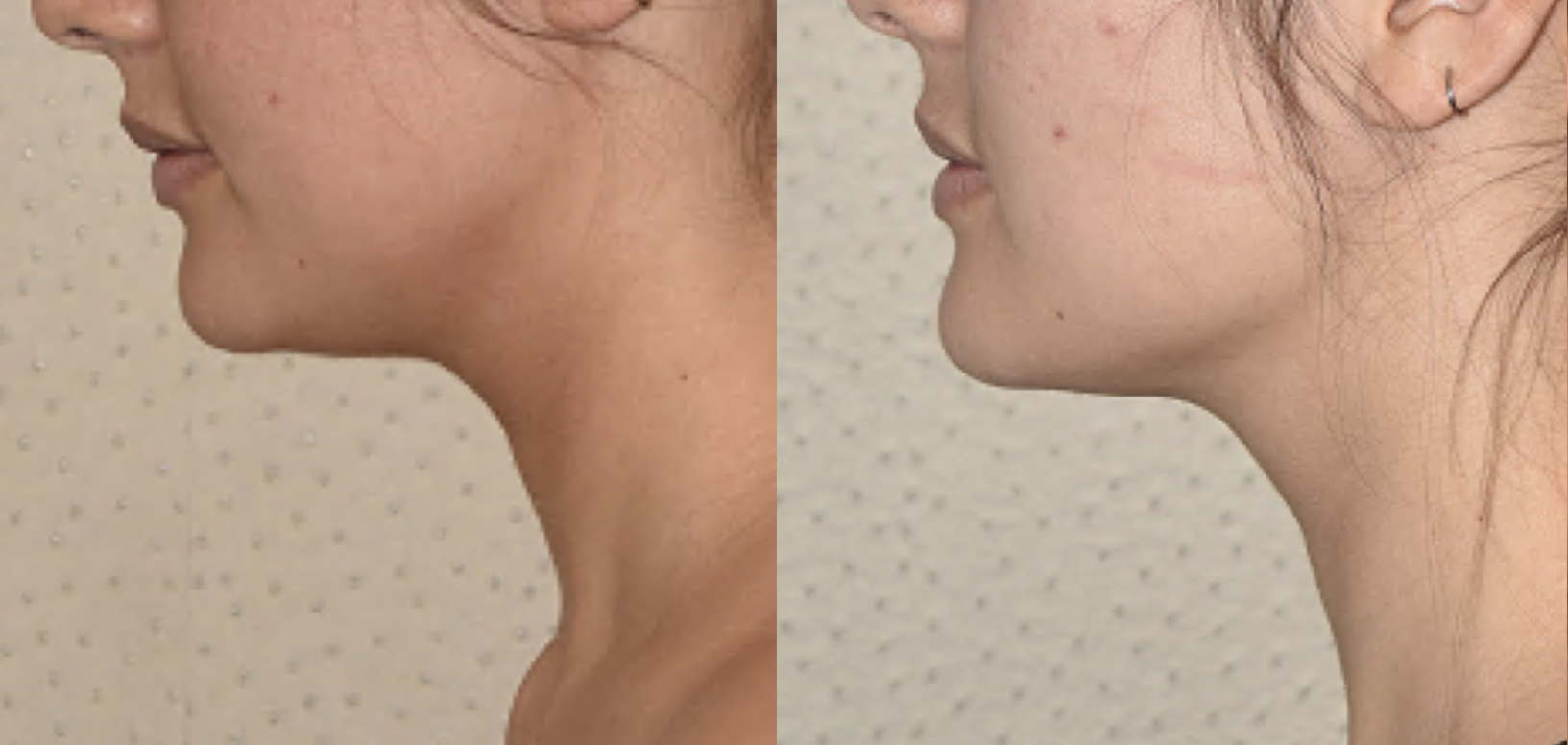 chin-lipo-before-after-age-40s