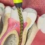 root-canal-treatment-banner