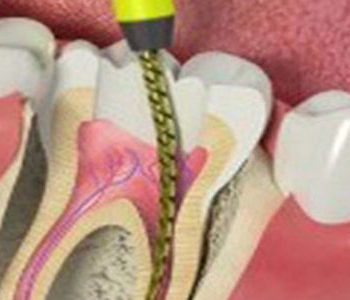root-canal-treatment-banner