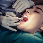 wisdom teeth extraction in Fullerton