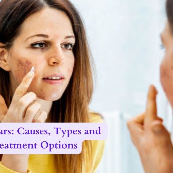 Acne Scars Causes, Types and Treatment Options