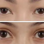 Double Eyelid Surgery