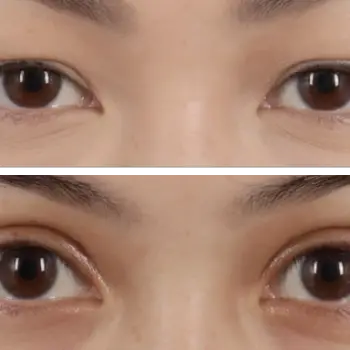 Double Eyelid Surgery