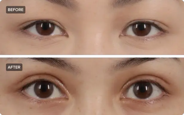 Double Eyelid Surgery