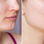 acne-scar-removal