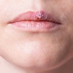 offpage-lip-pimples-around-lips-images