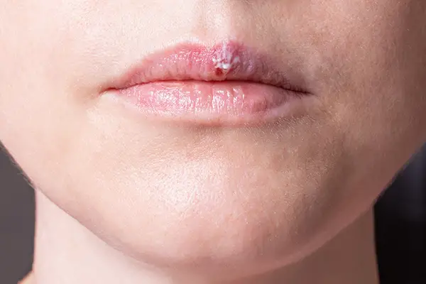 offpage-lip-pimples-around-lips-images