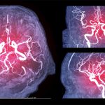 Cerebral Angiography Market