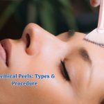 Chemical Peels Types & Procedure