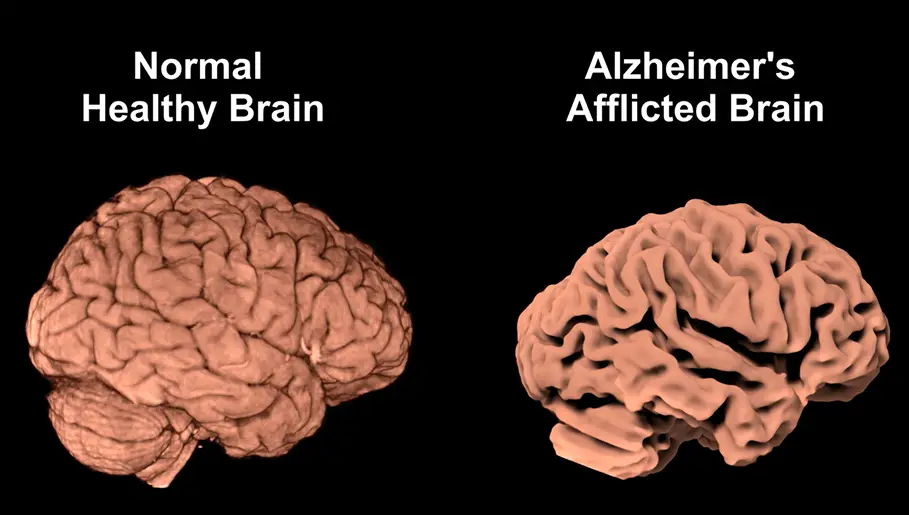 Normal_and_Alzheimers_Brains