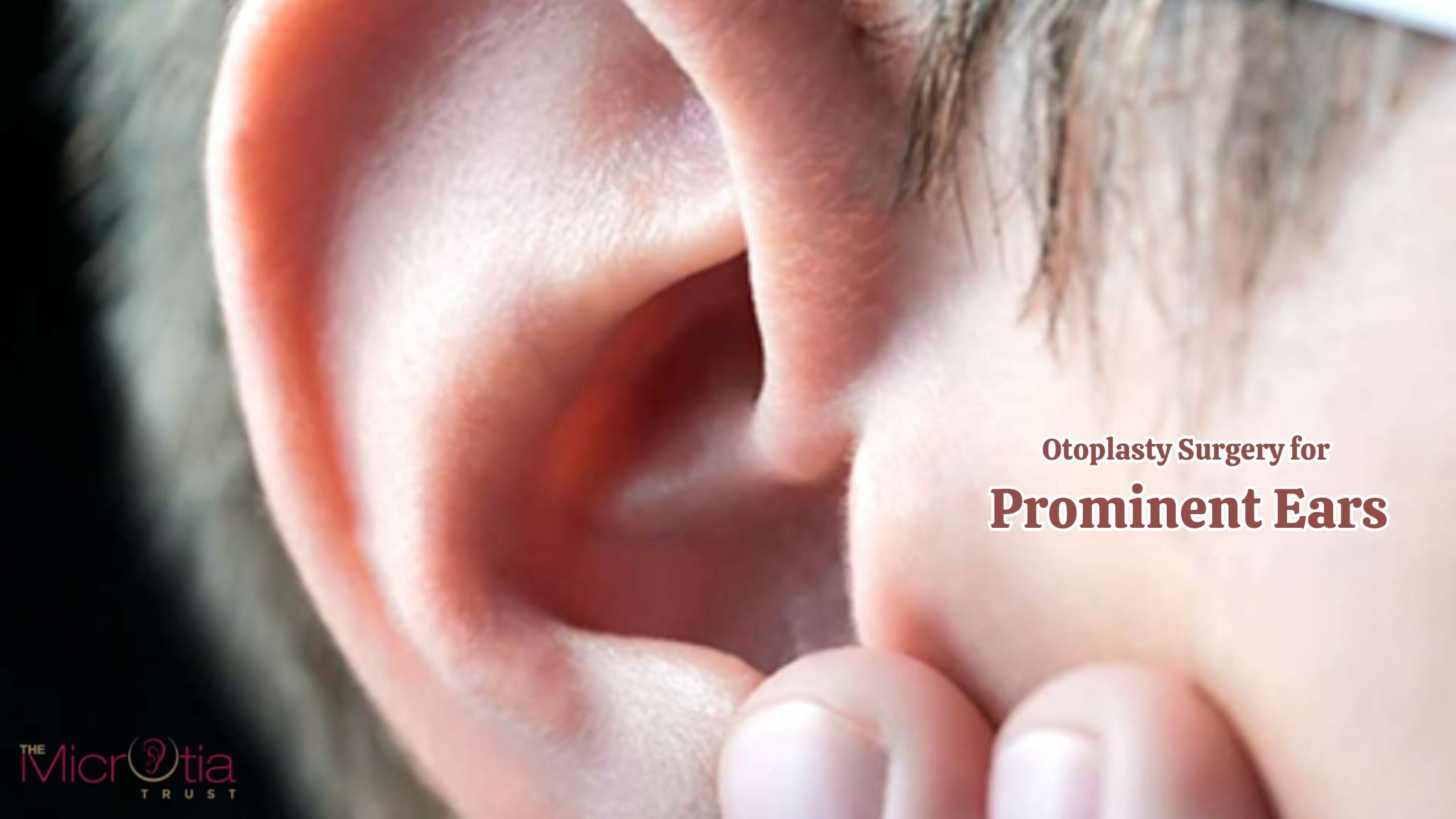 Otoplasty Surgery for Prominent Ears