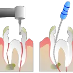 Root Canal Treatment Plumstead  Denvolve