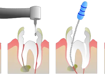 Root Canal Treatment Plumstead  Denvolve