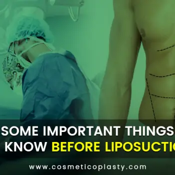 Some Important Things to know Before Liposuction