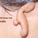 Treatment Options for Microtia