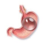 gastric balloon