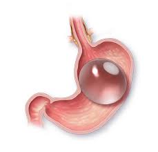 gastric balloon