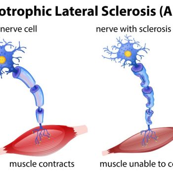 Amyotrophic Lateral Sclerosis (ALS) Disease 01