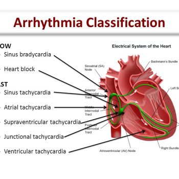 Arrhythmia+Classification