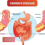 Crohns-disease-