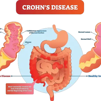 Crohns-disease-