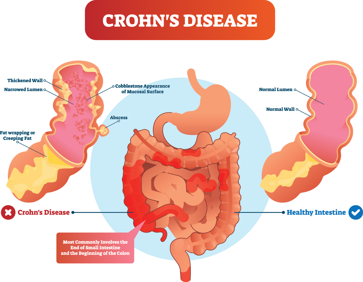 Crohns-disease-