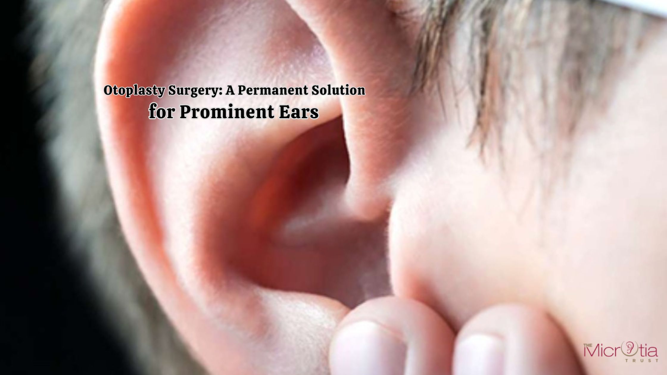 Otoplasty Surgery A Permanent Solution for Prominent Ears