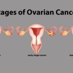 Ovarian Cancer Disease